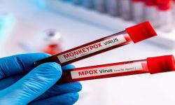 جدري القردة يتسلل إلى أكبر دولة سكانيا